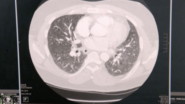 Featured image for Unraveling the Mystery of Long COVID Brain Fog