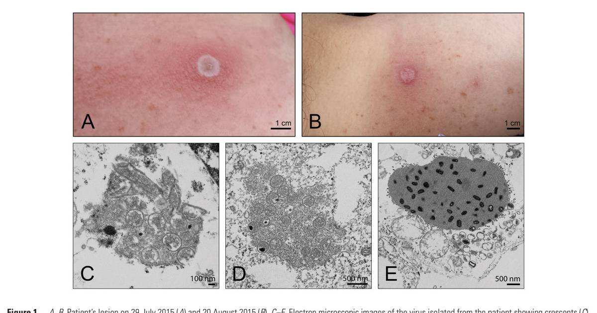 Featured image for "Alaskapox Claims First Fatal Victim in State"