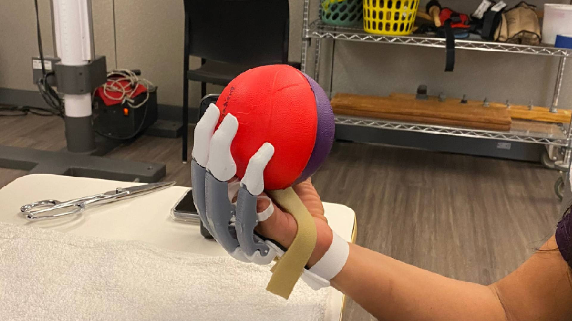 Featured image for "Revolutionary Open Access 3D Printable Prosthetic Wins Prestigious Award"