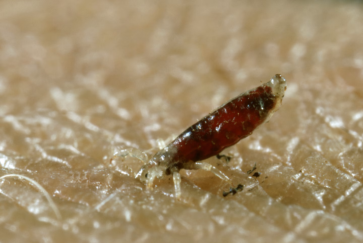 Featured image for CDC Alerts to Body Lice Infection Risk Among Homeless