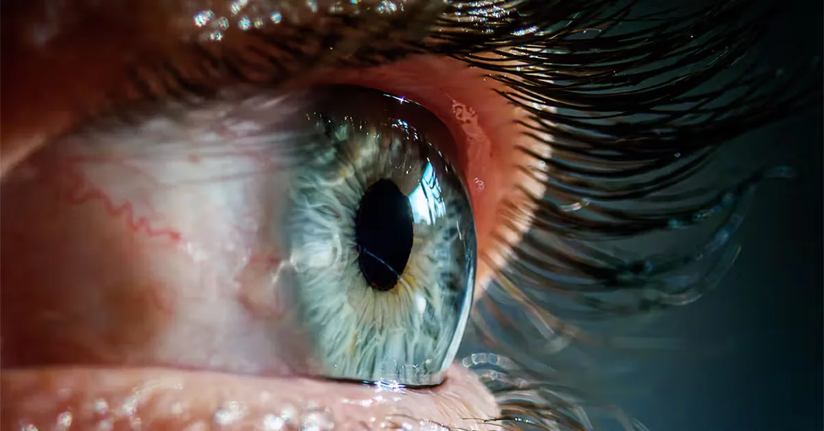 Diabetes Drug Metformin Linked to Slower Age-Related Vision Loss