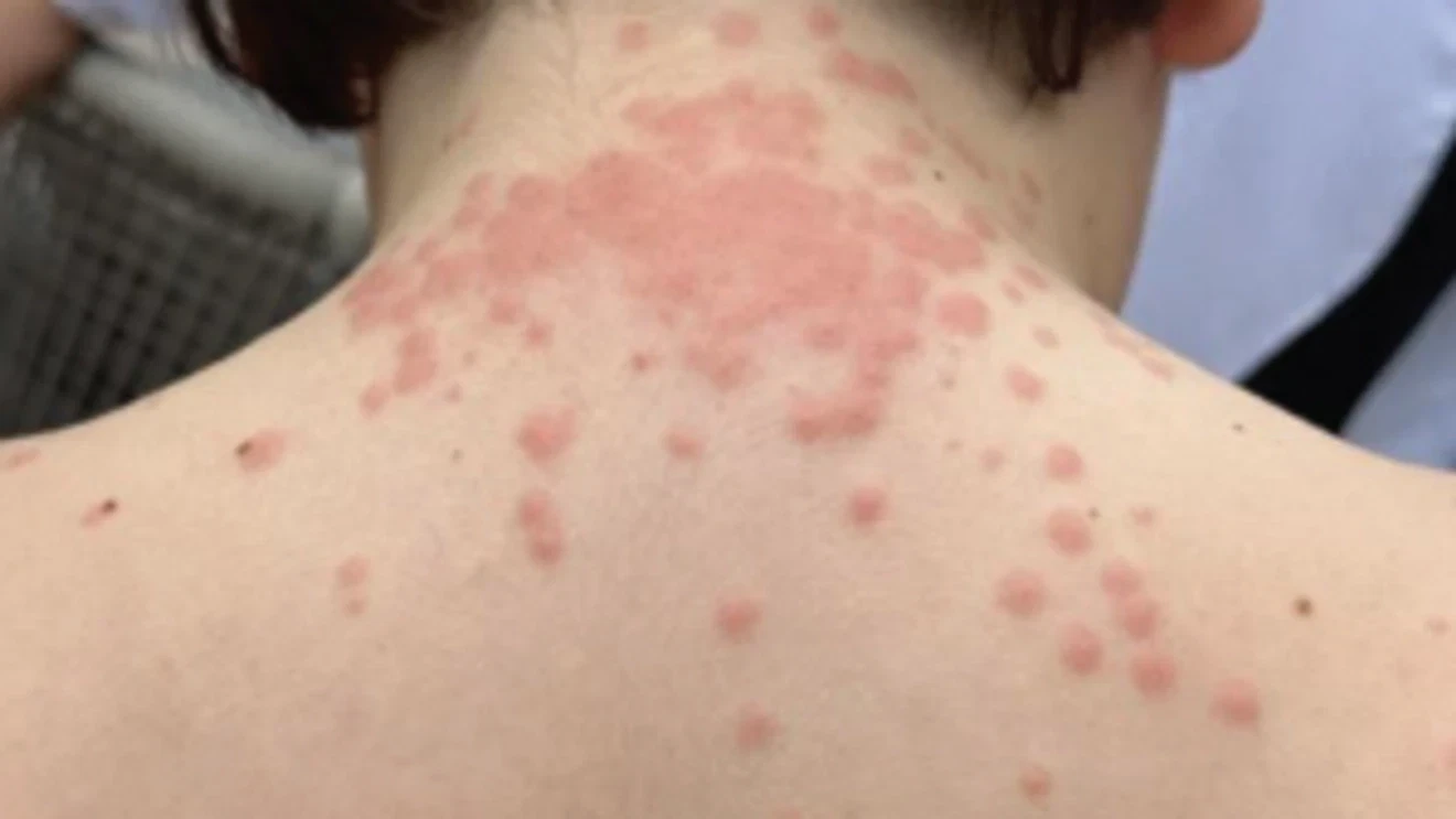 Featured image for Roanoke Family Sues Airlines Over Bed Bug Attack During Flight