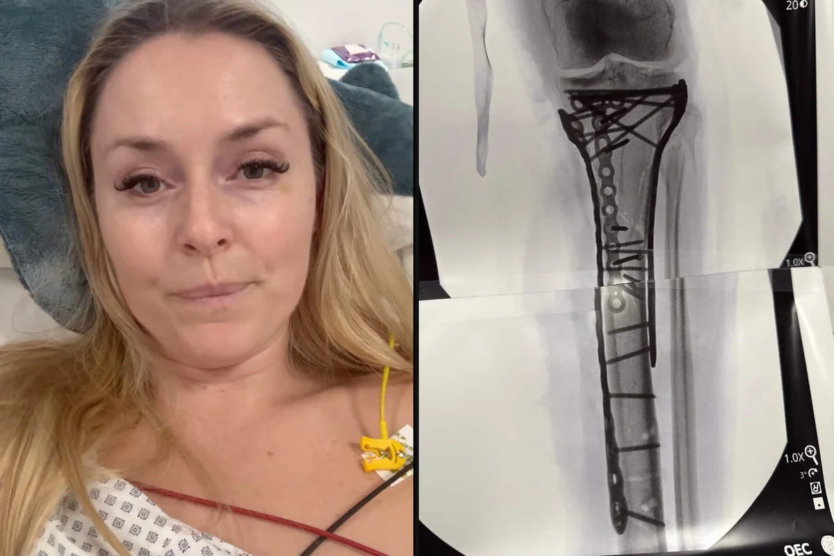 Vonn's Olympic crash leaves a long road to recovery and a cautious ski comeback