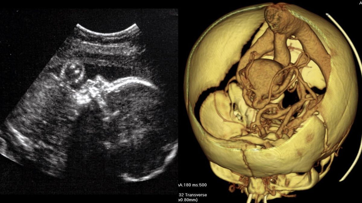 Featured image for Breakthrough Fetal Brain Surgery Performed Successfully in Womb