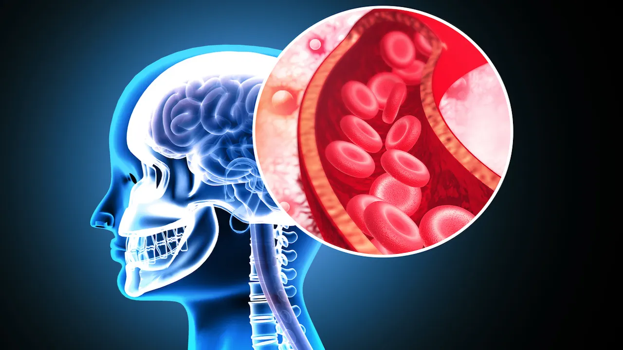 Featured image for Stanford Unveils Innovative Device to Double Stroke Clot Removal Success