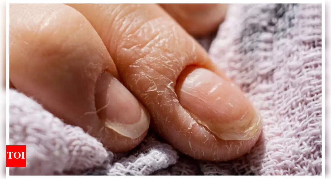 Featured image for 10 Hidden Nail Signs Indicating Health Issues