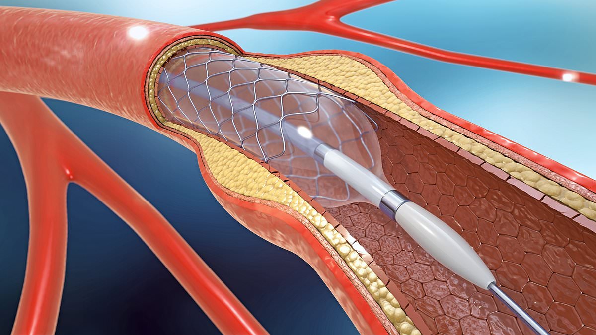 Featured image for The Costly Overuse of Heart Stents: A Burden on US Taxpayers