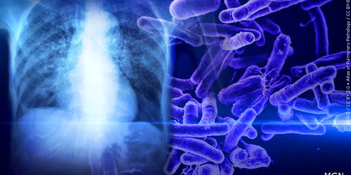 Featured image for Investigation Continues into Tuberculosis Case at Pitt County School