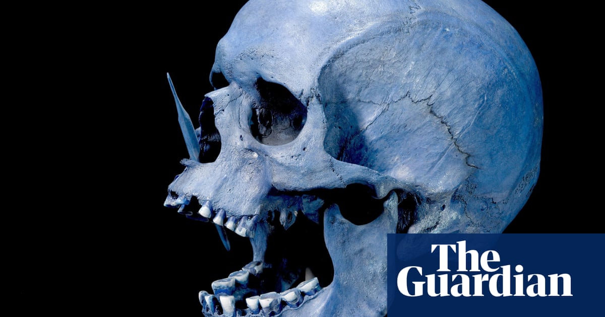 Featured image for "Unraveling the Ancient Origins of Multiple Sclerosis in Northern Europe"