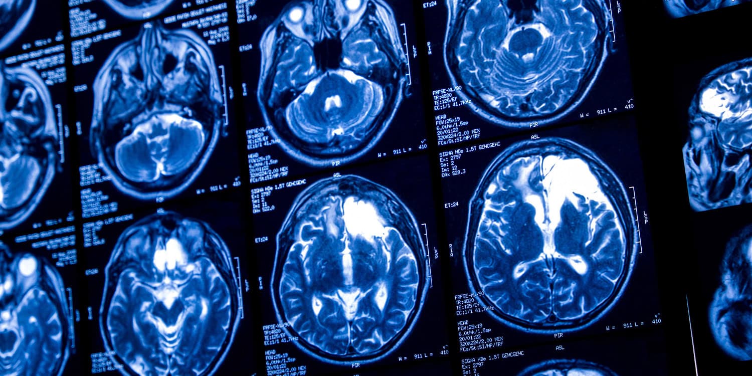 Featured image for Scientists Uncover Hidden Drainage System in Human Brain