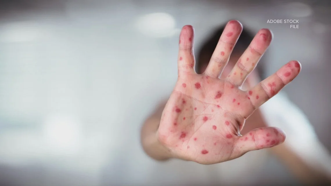 Jacksonville reports two pediatric measles cases linked to household exposure