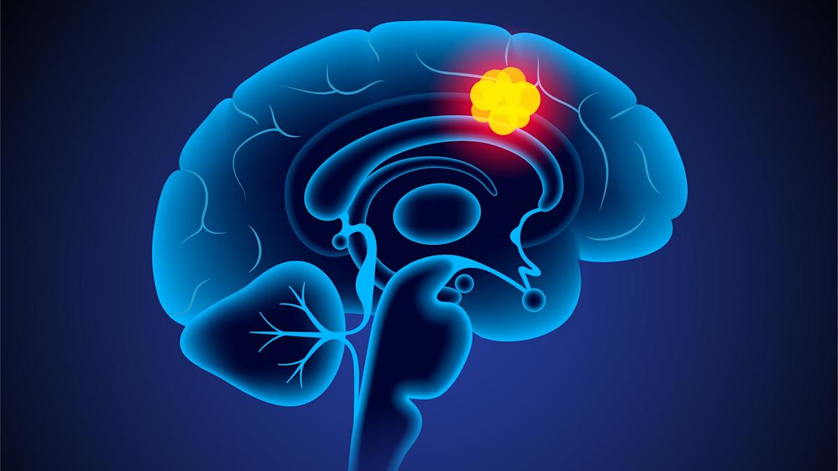 Featured image for Experimental drug trial causes man's brain tumor to vanish