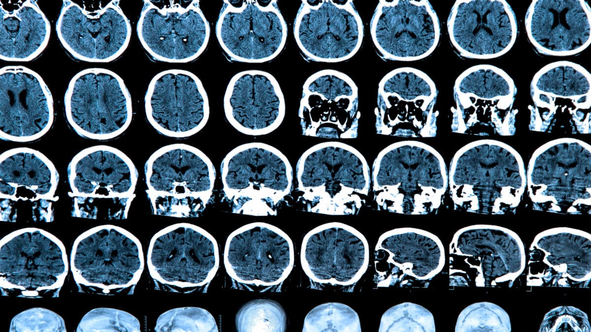 Featured image for Reevaluating the Brain Regions Behind Consciousness