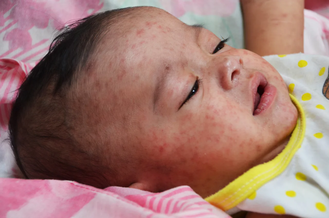 Alabama Investigates Possible First Measles Case in Years