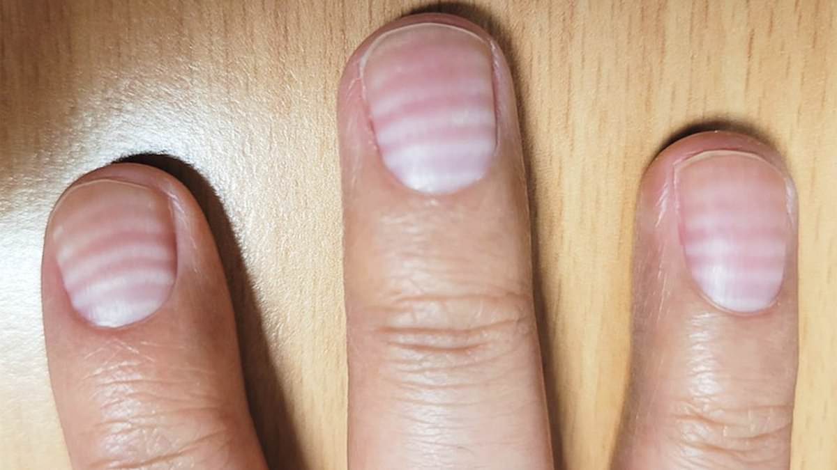 Featured image for "Man's Bizarre White Lines on Fingernails Reveal Cancer Drug Side Effects"