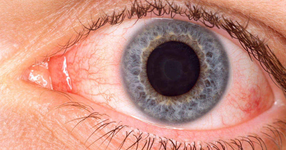 Featured image for COVID-induced pink eye leads to discovery of pus-filled 'pseudomembrane' in man's eye.