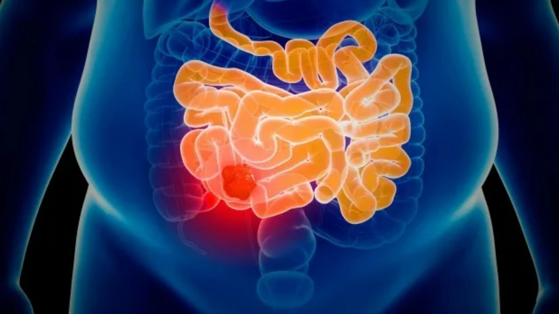 Featured image for "Breakthrough Bowel Cancer Drug Achieves 100% Success in Clinical Trials"