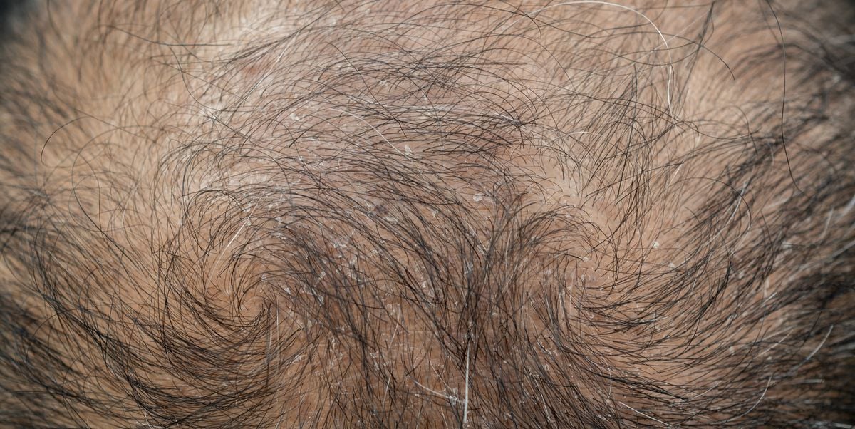 Featured image for Pantry Chemical Shows Promise for Hair Regrowth