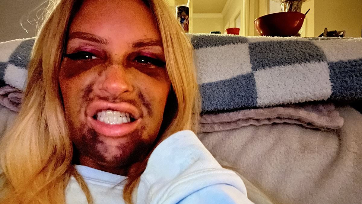 Featured image for "Dental Implants Turned My Face into a Swollen, Bruised Nightmare"