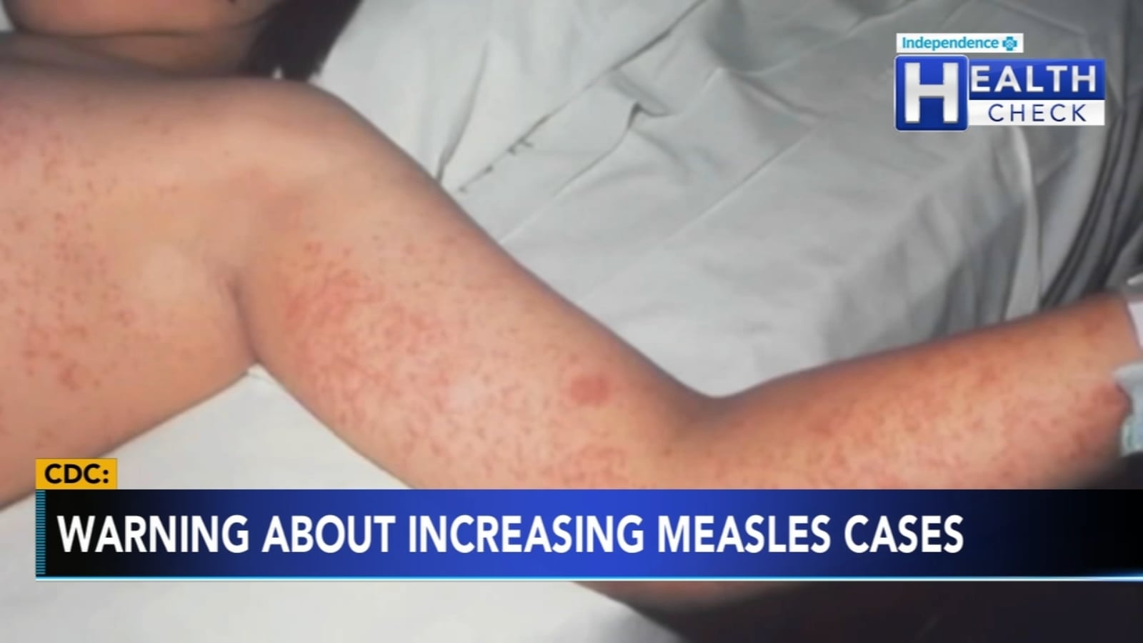 Featured image for "Rising Measles Cases Prompt CDC Warning for Health Care Workers"