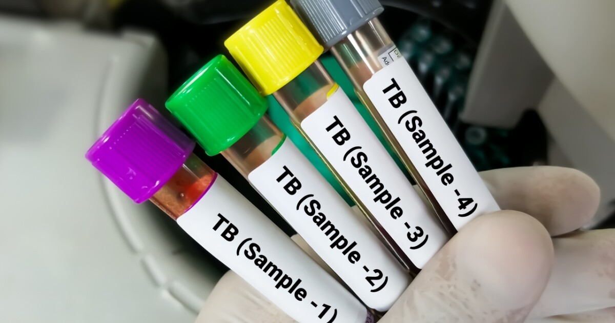 Featured image for Tuberculosis Outbreak at Olathe Northwest High School: Latest Updates