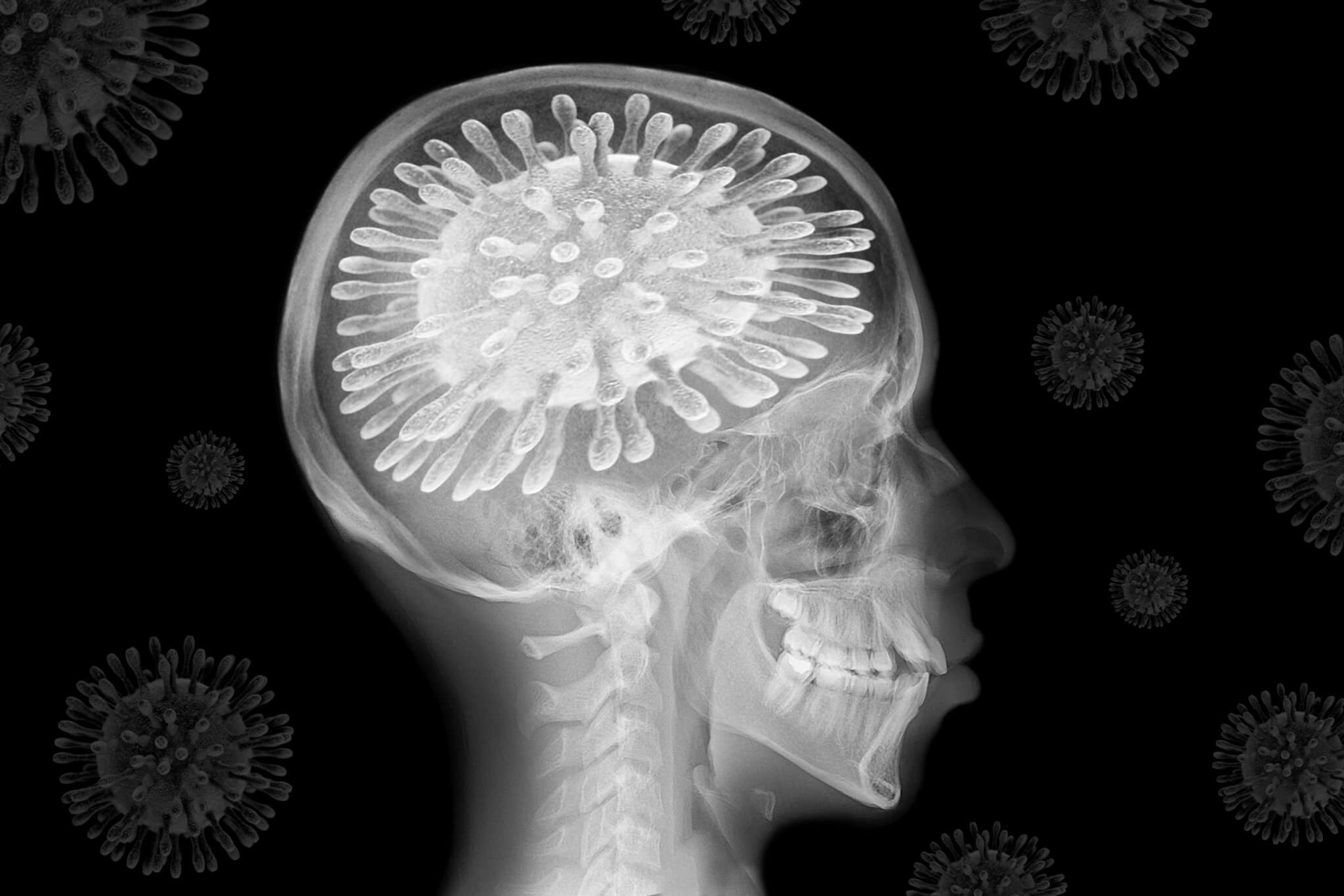 COVID-19 Pandemic Accelerated Brain Aging by 5.5 Months