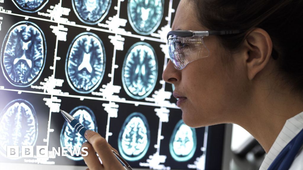 Breakthrough Alzheimer's Drug Donanemab Offers Hope for Disease Treatment