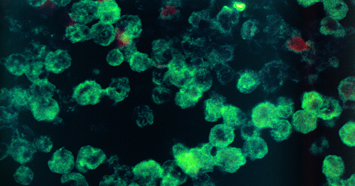 Fatal Brain-Eating Amoeba Claims Another Life in Georgia