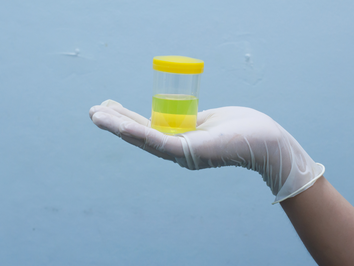 Featured image for Decoding Your Health Through Urine Color