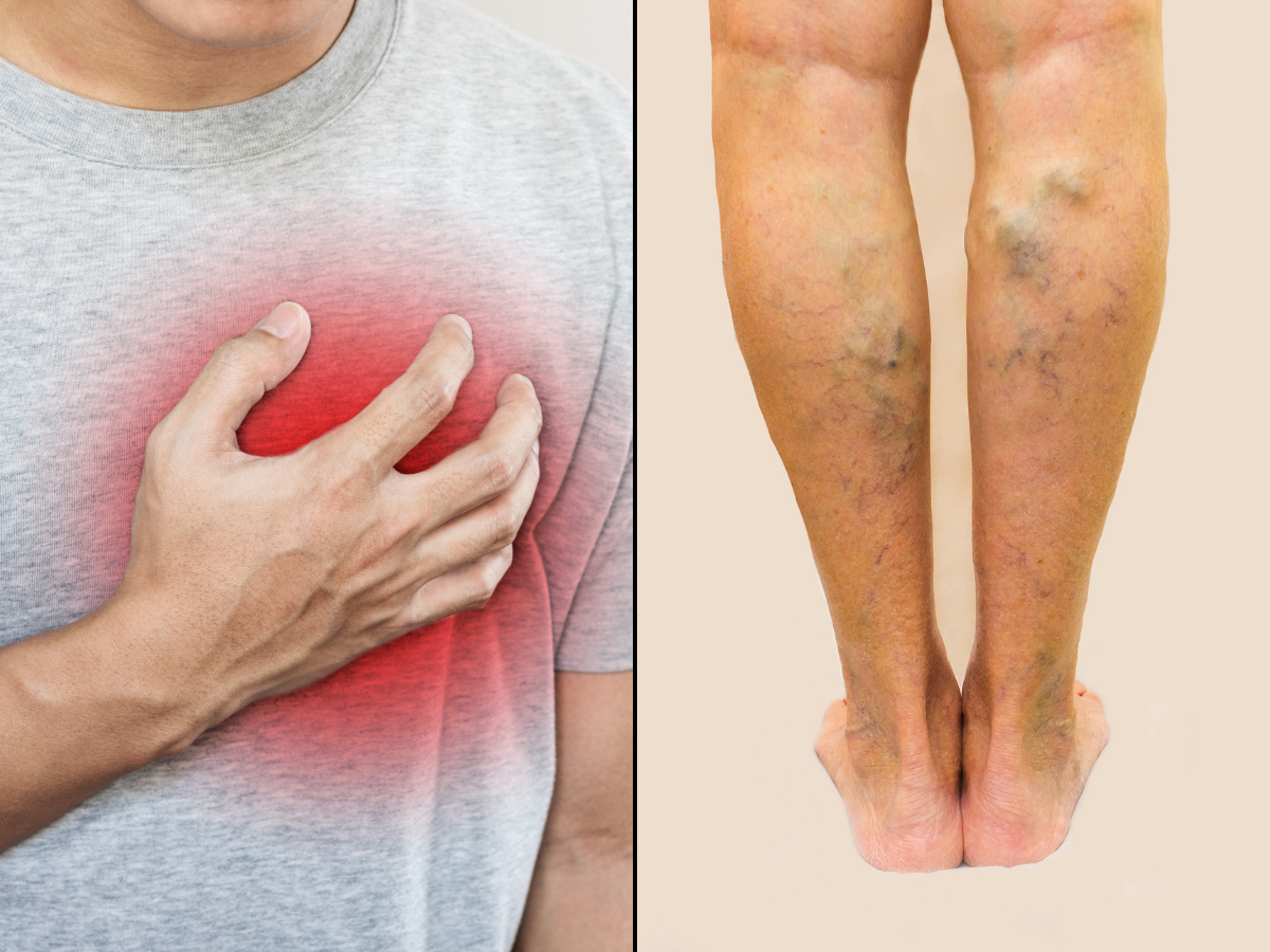 Featured image for Lower leg swelling may indicate heart disease