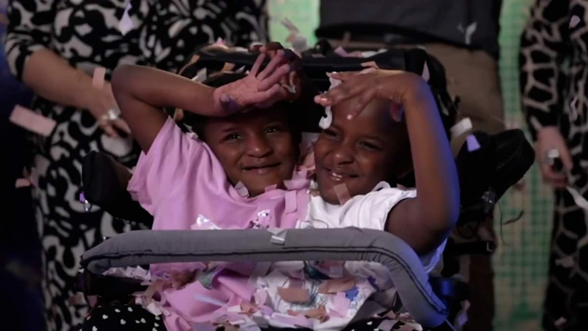 Featured image for "Conjoined Twins Defy Odds and Inspire Heartwarming Moments"