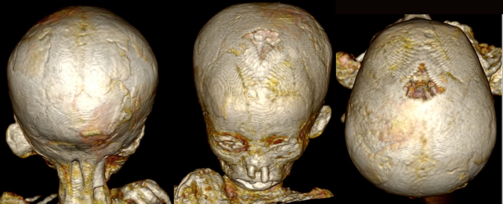 Ancient Illness Found in Egyptian Child Mummies