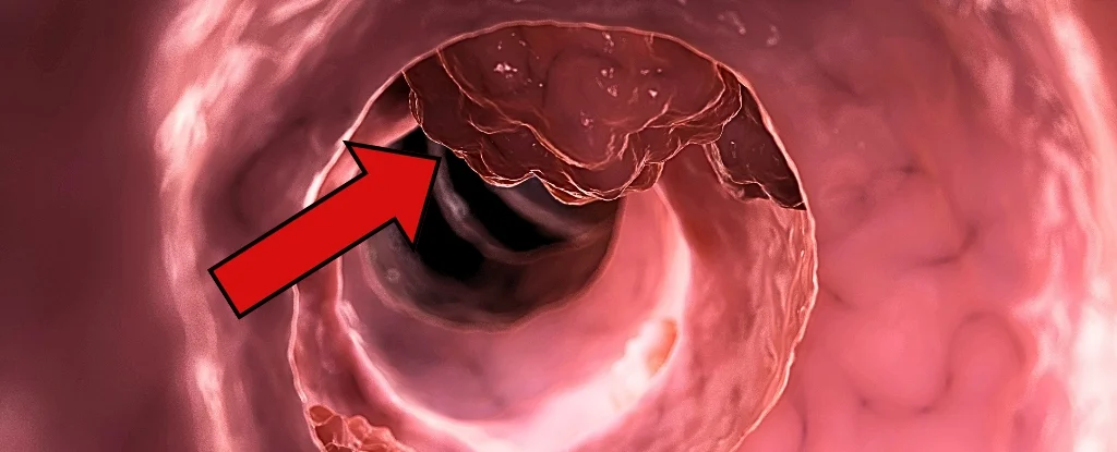 Featured image for Aspirin Significantly Reduces Colorectal Cancer Recurrence