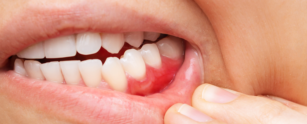 Featured image for Scientists Find Diet May Lower Gum Disease Risk
