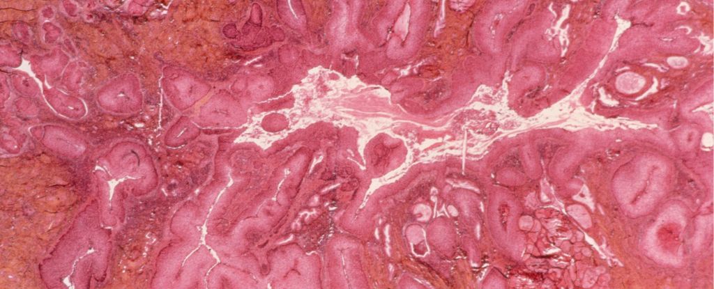 Featured image for HPV Vaccine Leads to Sharp Decline in Cervical Cancer Deaths Among Young Women