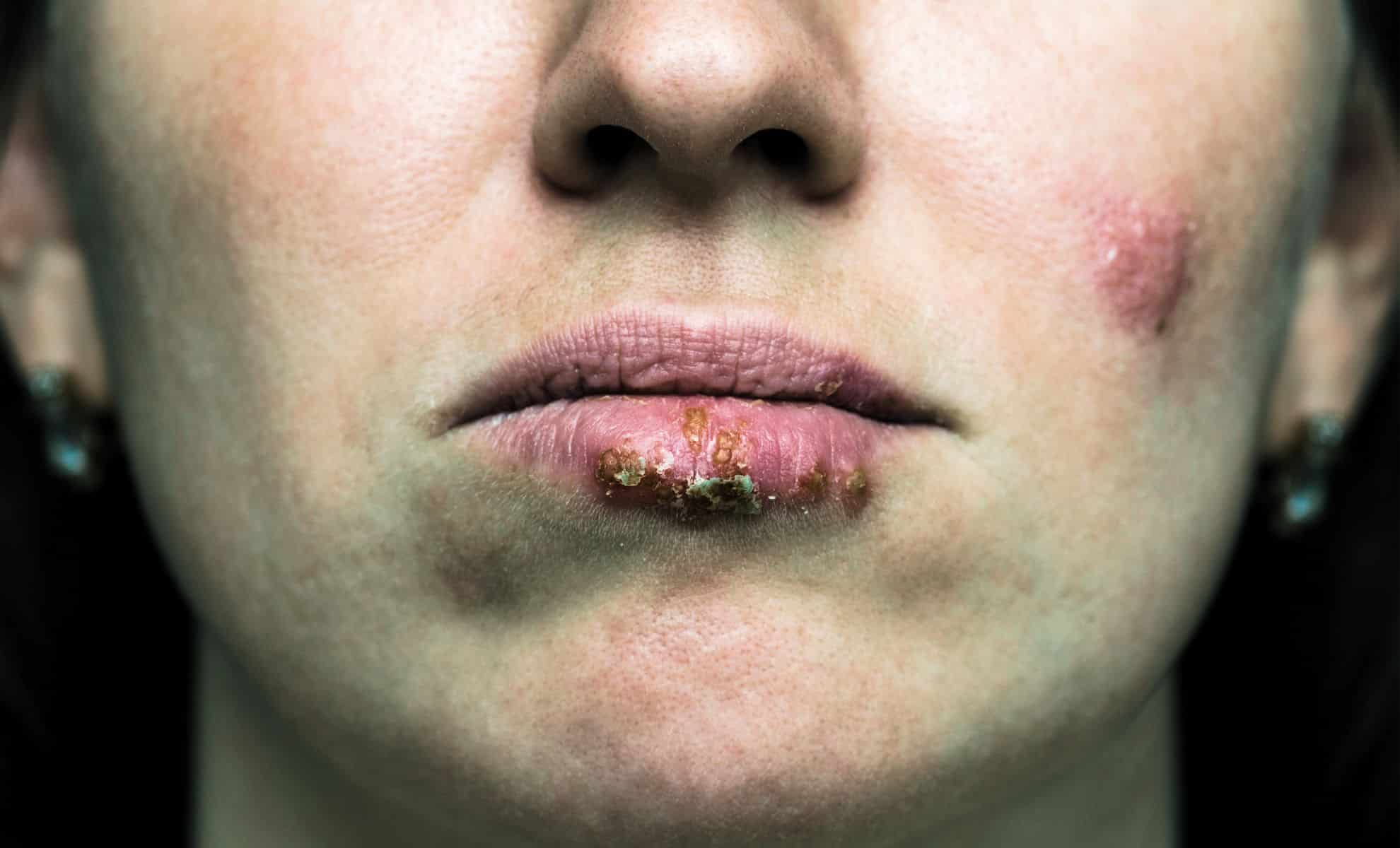 Featured image for Scientists Discover a Single Enzyme to Halt Herpes Virus Genome Manipulation