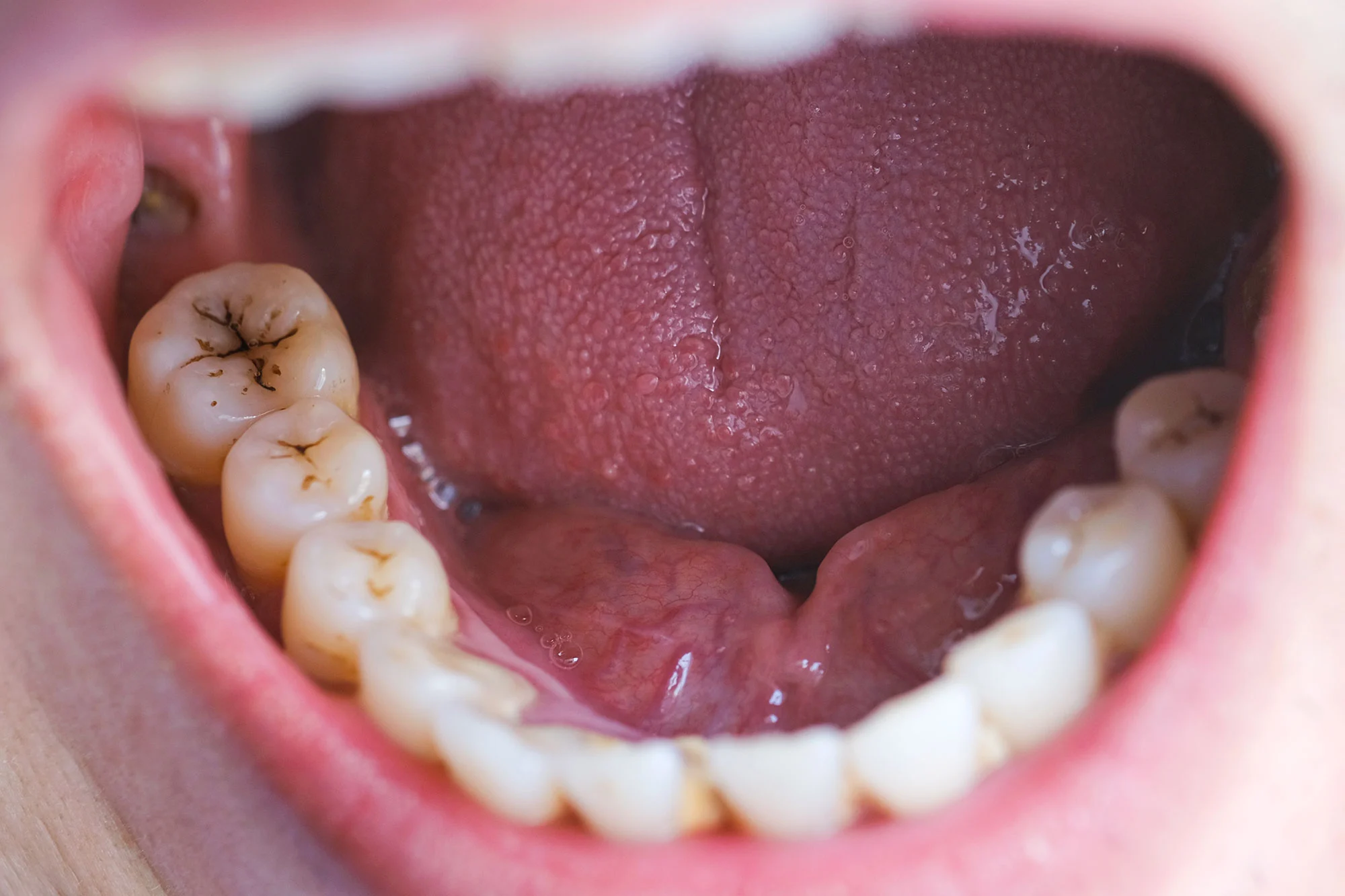 Featured image for Effective Topical Treatments Prevent Childhood Cavities for Years