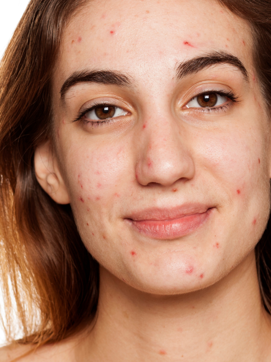 Featured image for "Identifying and Treating Hormonal Acne"