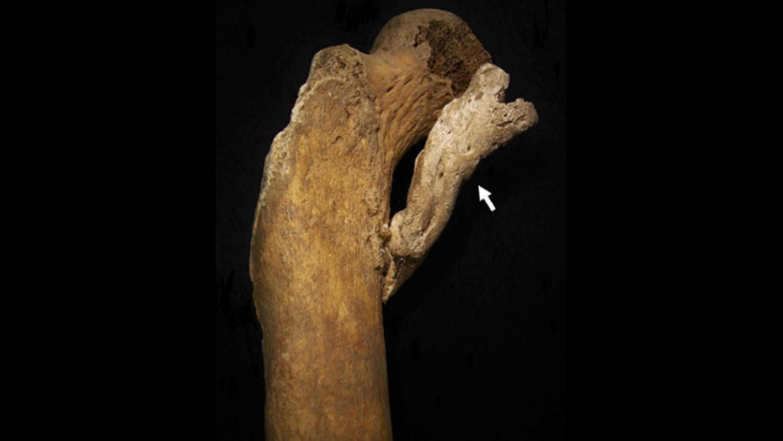 Featured image for Ancient Woman's Leg Injury Led to Unusual Bone Growth, Experts Discover.