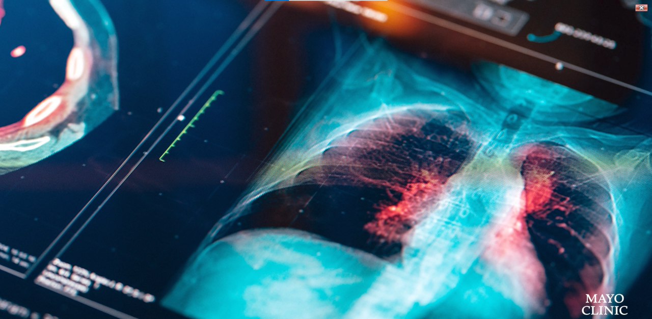 Featured image for Rising Lung Cancer Rates in Younger Women Baffle Experts