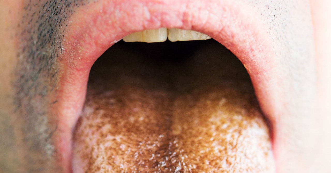 "Unveiling the Bizarre Phenomenon: Ohio Man's Tongue Sprouts Green Hair"