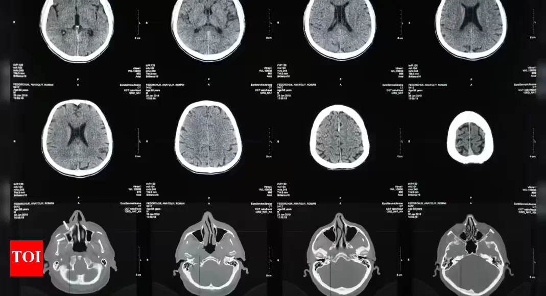 Sleep Patterns and the Risk of Alzheimer's Disease
