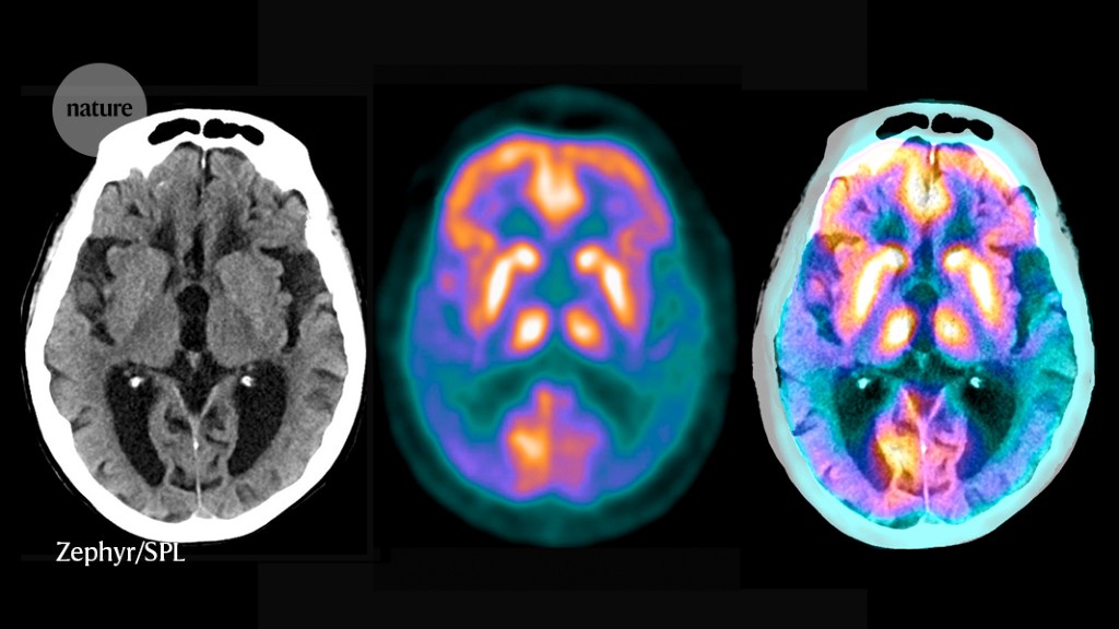 Featured image for Advancements in Alzheimer's Therapies: Current Trials and Future Prospects