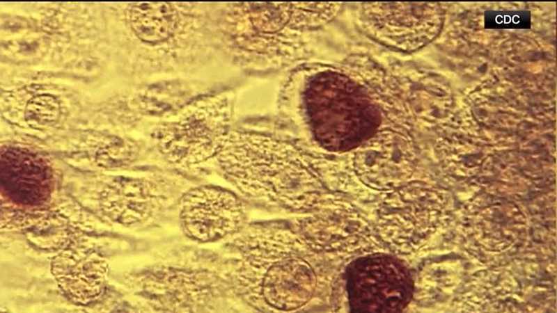 Featured image for Syphilis Cases Surge Across the United States