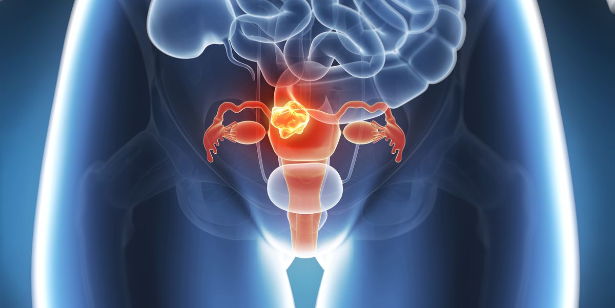 Featured image for 5 Hidden Signs of Endometrial Cancer Doctors Warn About