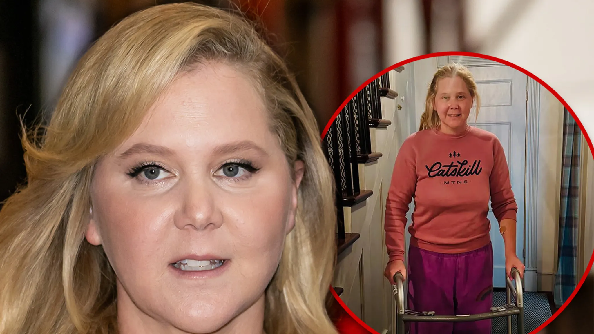 Featured image for Amy Schumer Shares Update After Back Surgery and Using Walker