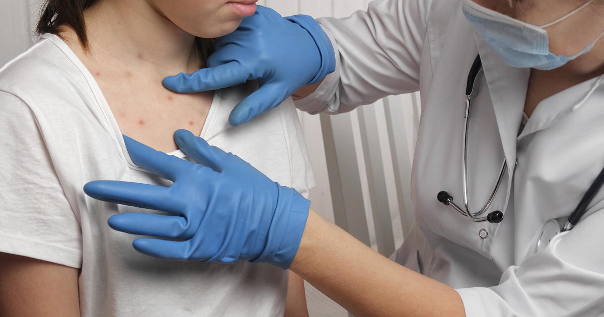 Featured image for Measles Outbreaks: Understanding the Threat to Herd Immunity