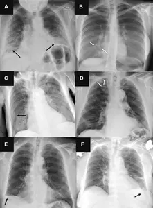 Featured image for Radiologists trump AI in detecting lung diseases on chest X-rays