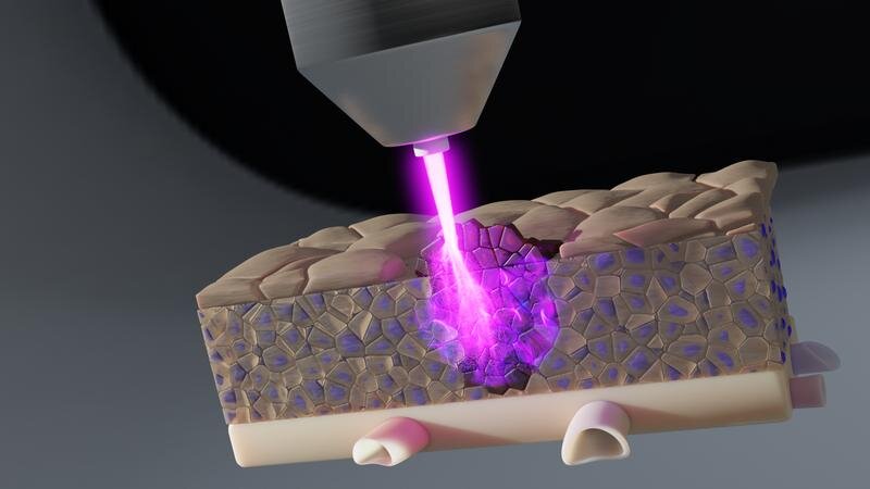 Featured image for Deep Tissue Cold Plasma Therapy for Cancer Treatment