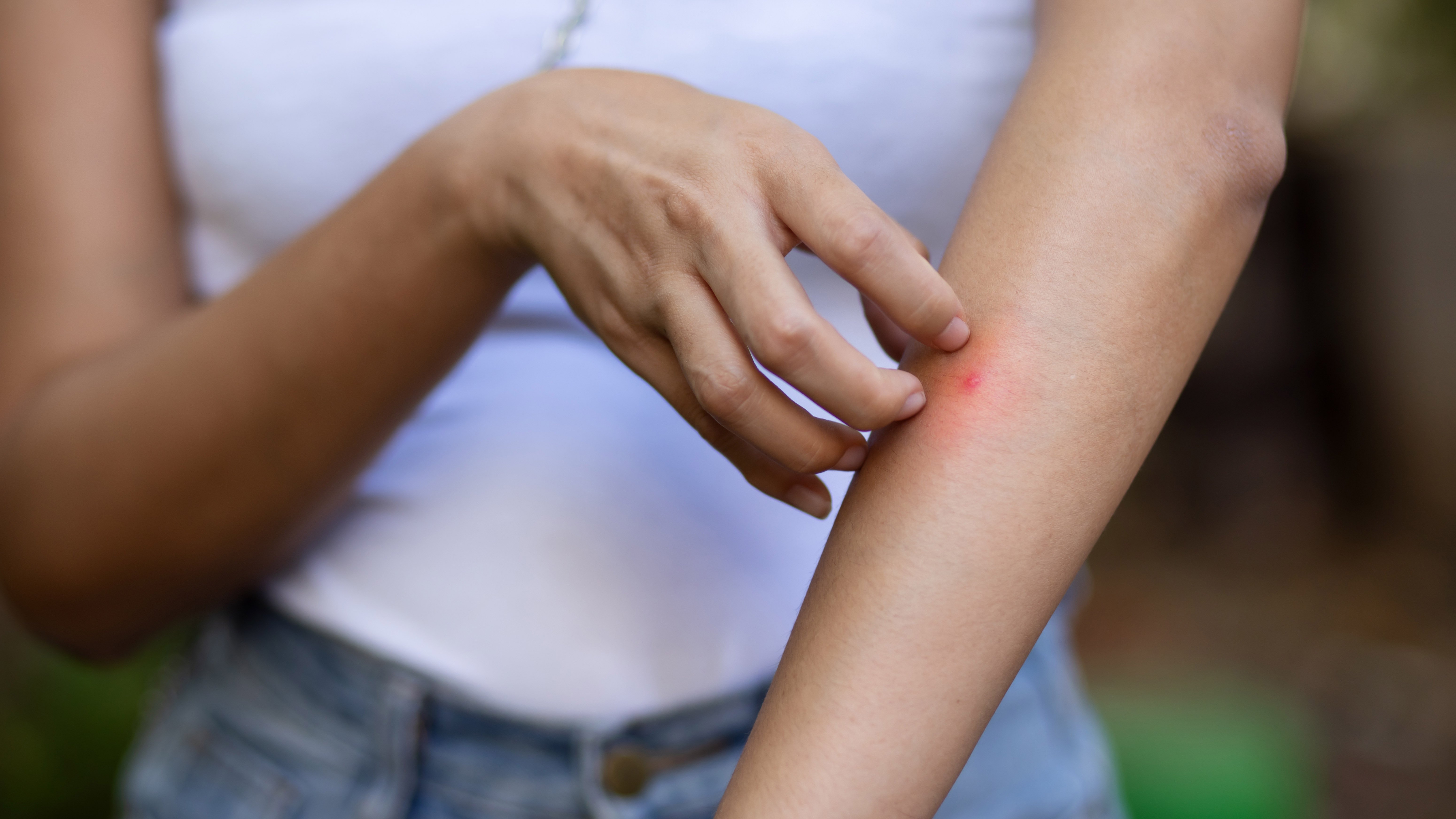 Featured image for Top Tips to Prevent Mosquito Bites This Summer